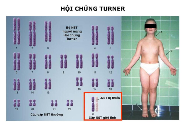 Hội chứng Turner: do mất đi một số gen trên nhiễm sắc thể X
